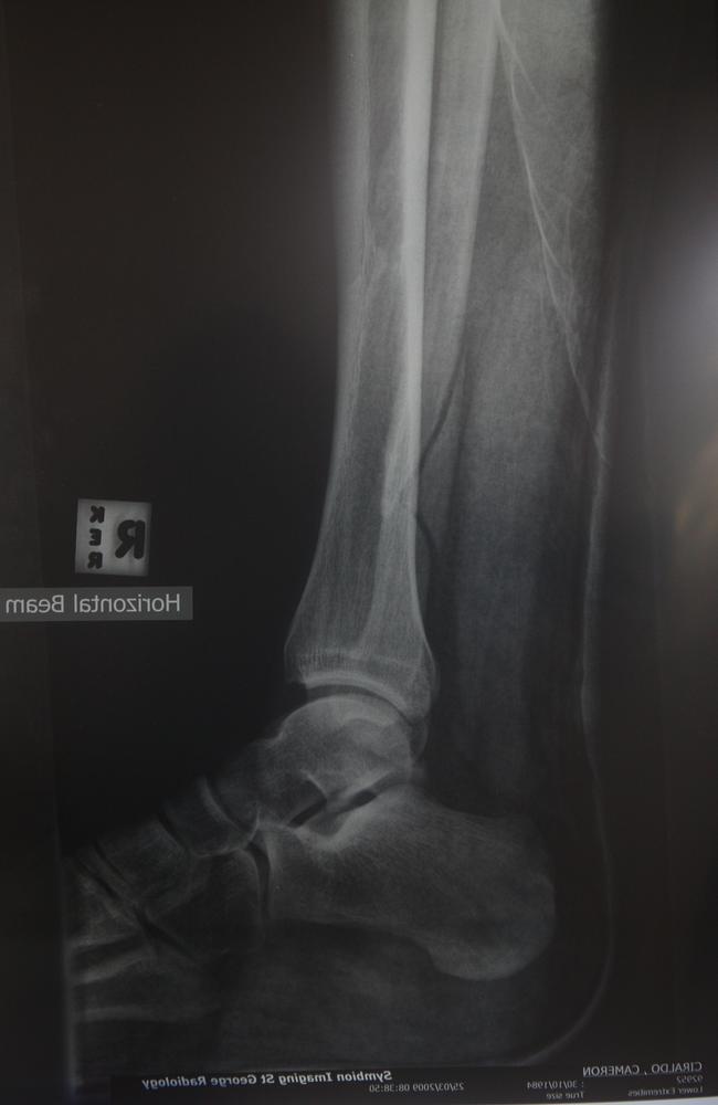 X-ray of Ciraldo’s broken fibula.