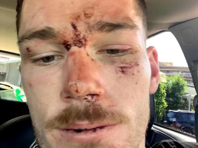 Canberra Raiders player Tom Starling after an incident with police on the Central Coast. Picture supplied