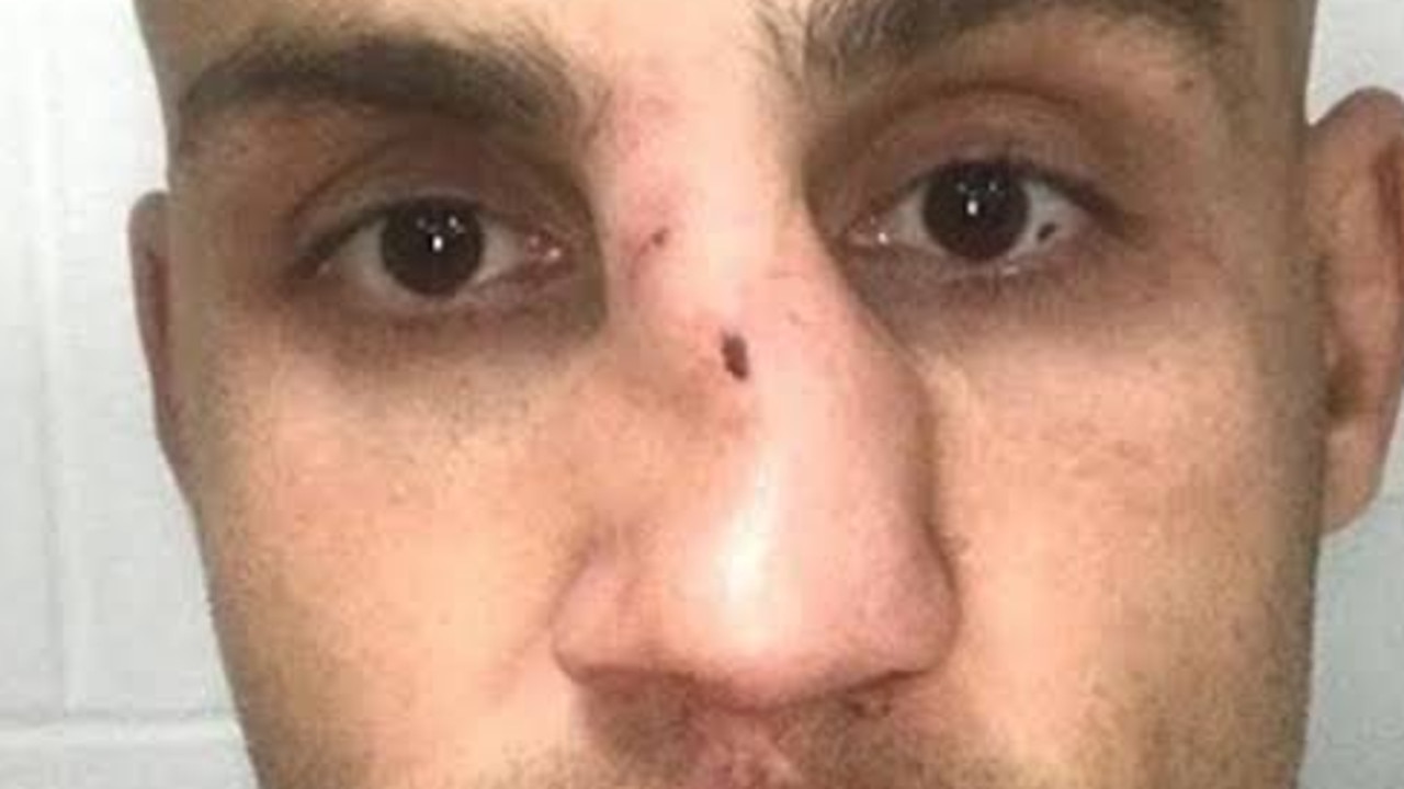 Blake Ferguson's busted nose no one will pay to fix.