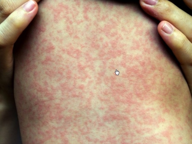 Measles rash is one of the last symptoms.