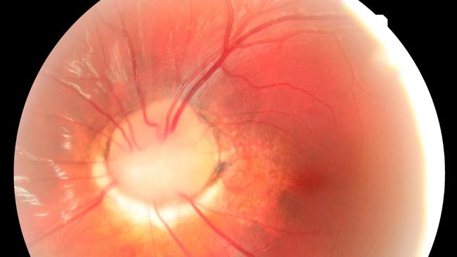 Aidan’s test revealed his left retina hadn’t formed correctly