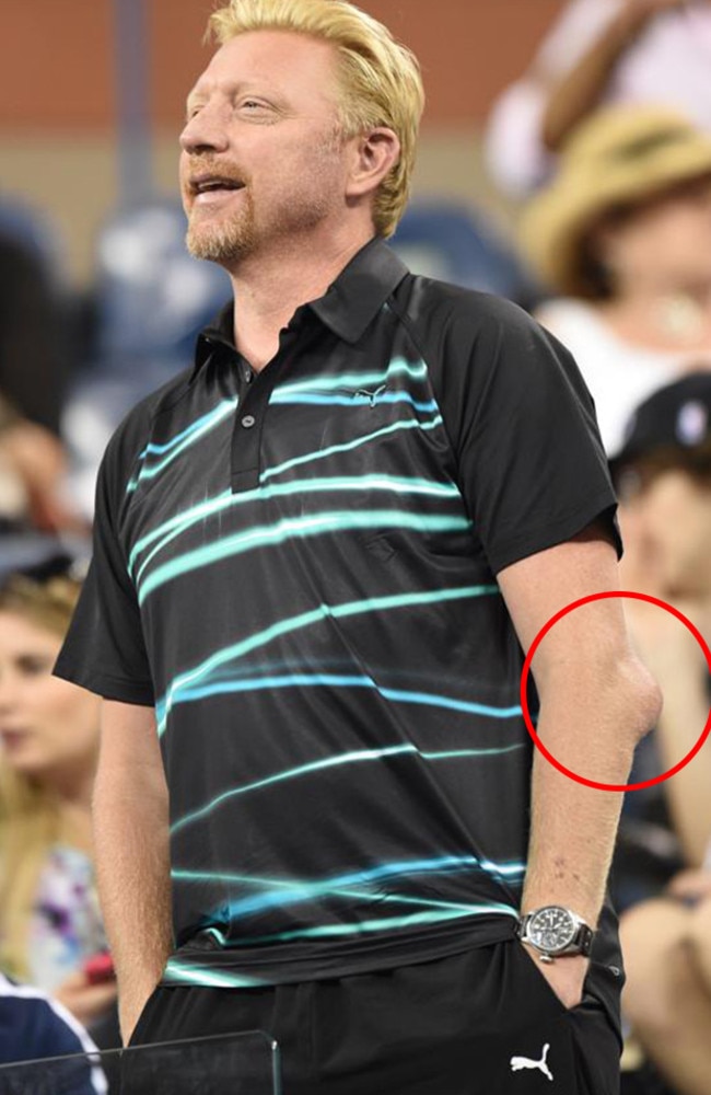 Boris, that is quite a lump on your elbow.