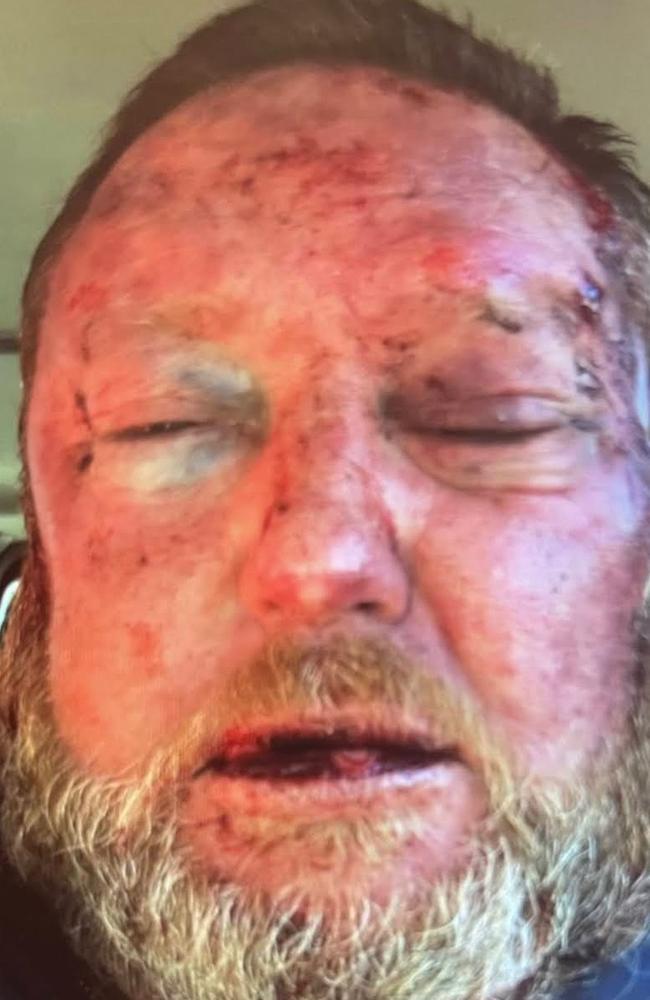 Former Bandidos National President Jason Addison, image of him after being bashed Picture Supplied