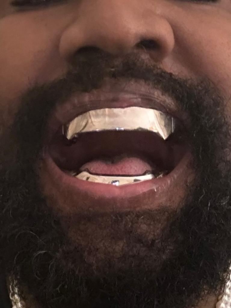 The implants are known as “fixed prosthodontics,” which the rapper designed entirely by himself. Picture: Instagram/@kanyewest