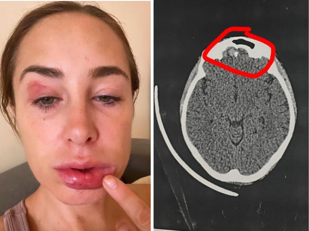 Melbourne DJ Courtney Mills reveals brutal Bali injuries The Courier Mail