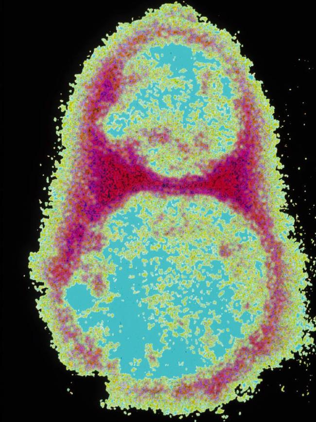 A new type of virus has been created that can kill every type of cancer in a petrie dish. Picture: Supplied