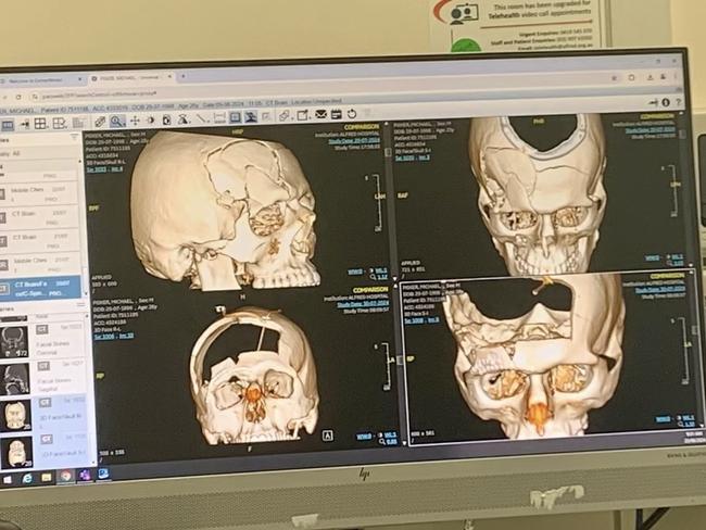 0X-rays of Pisker’s head injuries. Picture: Supplied