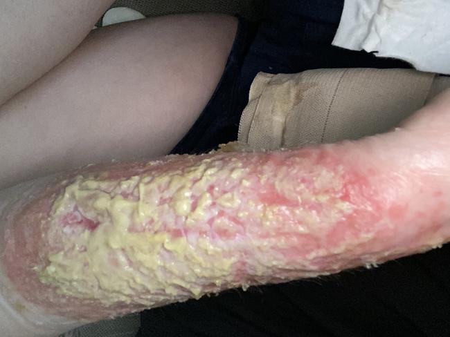 Jenna Allen’s arm – more than eight years after she was bitten by a redback spider. Picture: Supplied