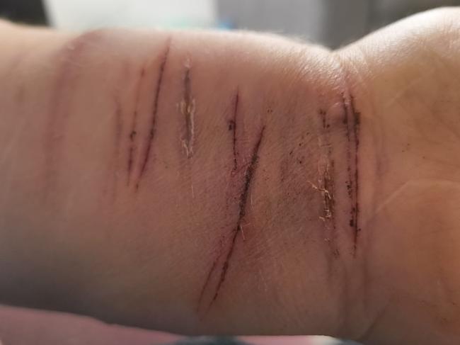 Injuries on the wrist of a teenager who claimed her care was compromised. Supplied