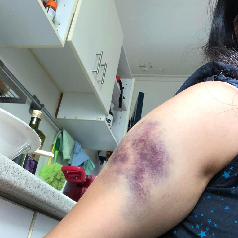 Zoey Chan was hit by an e-scooter at Coorparoo.