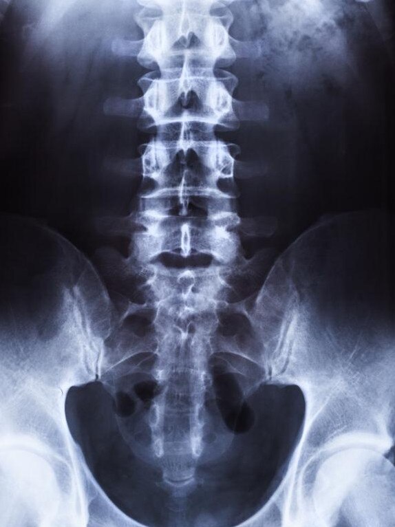 How a healthy spine should look.