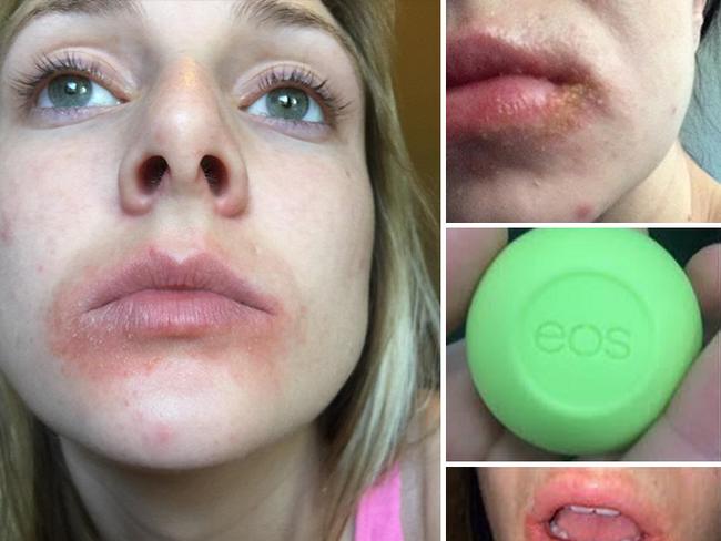 Customers have shared images of their cracked and infected lip son the eos Facebook page.