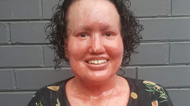 Carly Finlay has a chronic skin condition called ichthyosis. Picture: Instagram