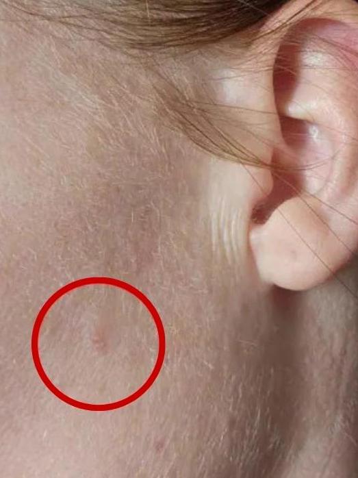 What she thought was a pimple turned out to be skin cancer. Picture: Facebook.