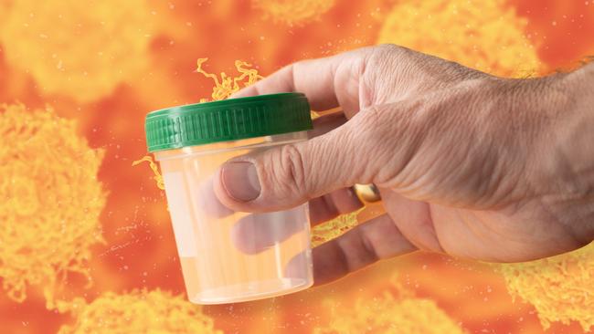 Analysis of prostate cancer cells allowed scientists to identify biomarkers that can be detected in urine. Picture: Getty Images/The Australian