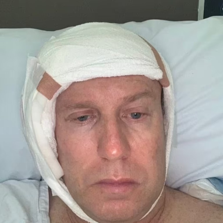 The TV host was first diagnosed with skin cancer in 2020 after a melanoma on his temple needed to be removed. Picture: X.