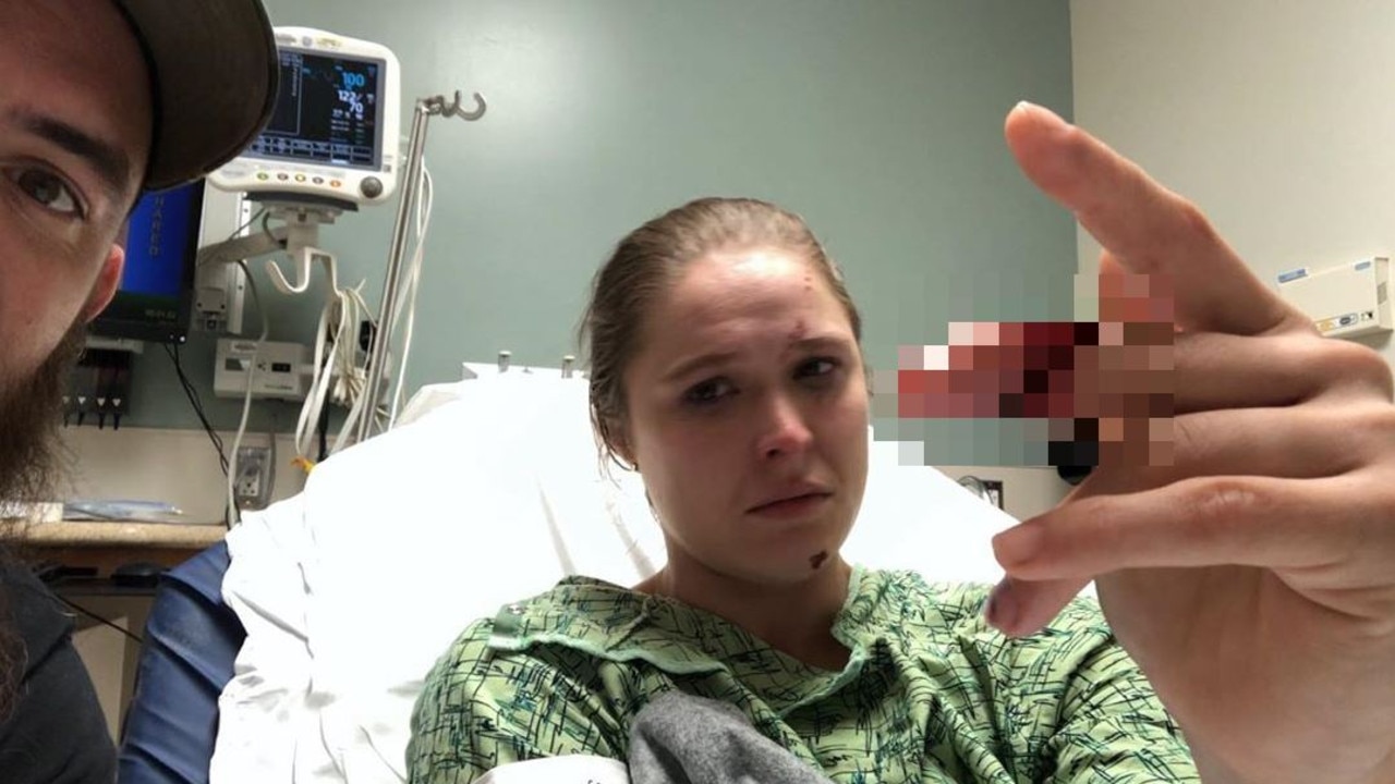 Ronda Rousey shows off her horrific finger injury.