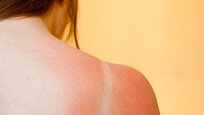 Why you should never treat a sunburn with vinegar