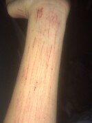 The girl has shared photos of her self harm. Photo: Supplied