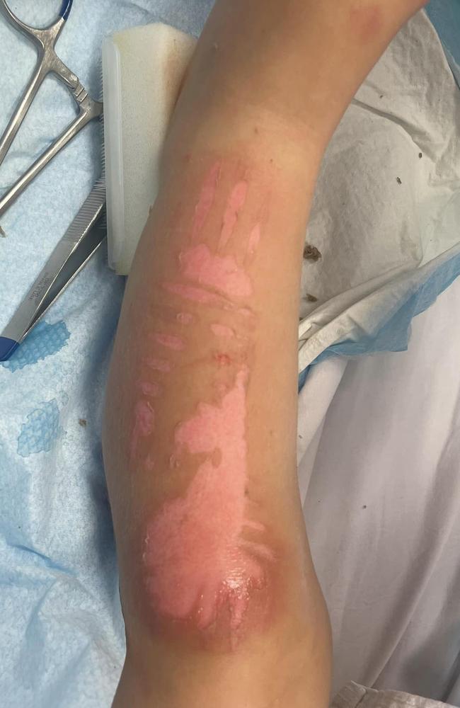 A young child playing at a Port Macquarie water park fell onto a nearby metal grate leaving severe burns on her hands and legs requiring hospital treatment.