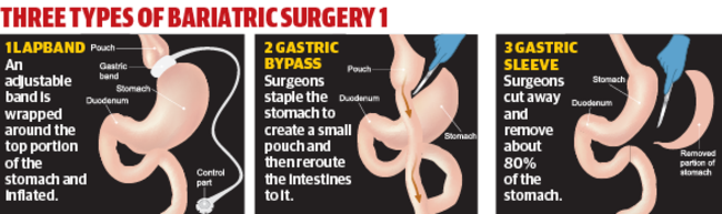 Three types of bariatric surgery