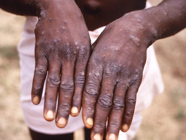 A patient with lesions on the hands from monkeypox. Picture: AFP/Brian W.J. Mahy/Centers for Disease Control and Prevention