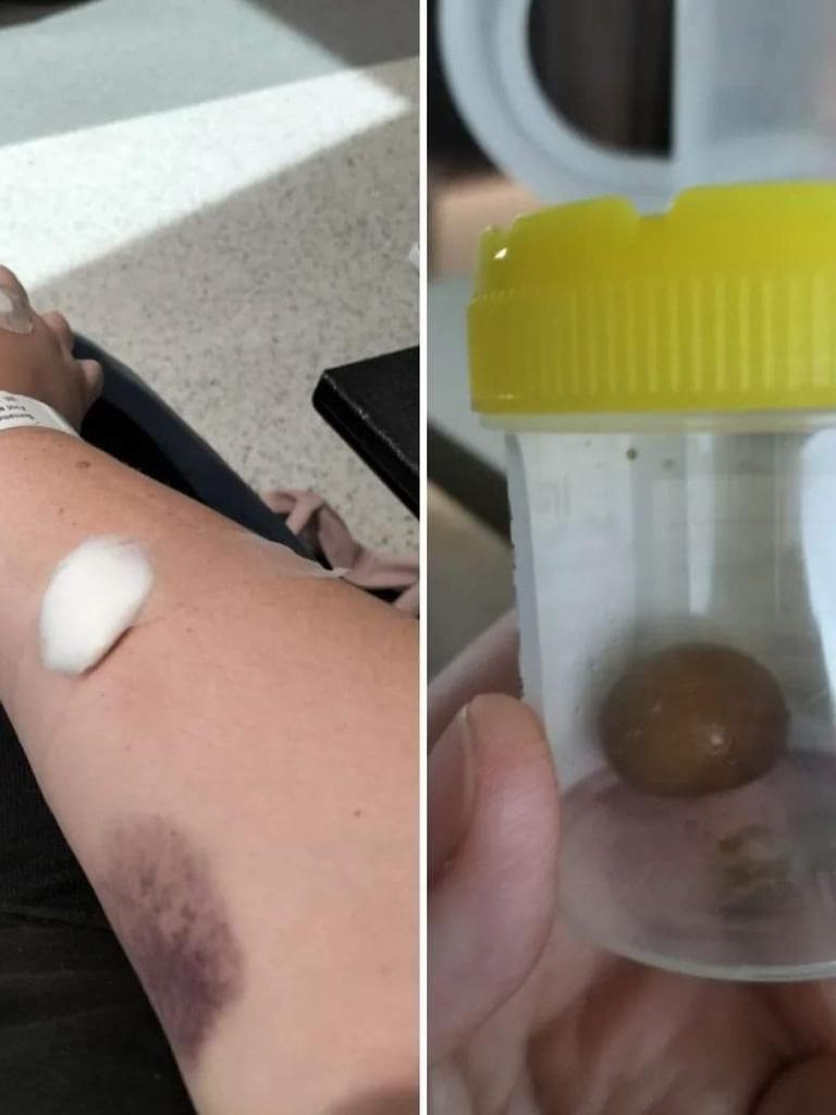 Natasha Van Eck following her gallbladder removal surgery, doctors removed a gallstone. Picture: Supplied