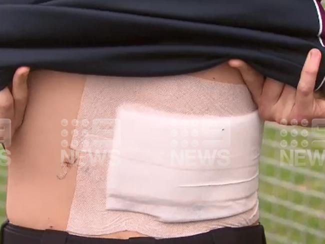 The 15-year-old suffered a centimetre-deep gash and to his back as a result. Picture: Channel 9