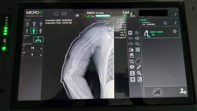 An X-ray showing the exit wound from a shot Ukrainian soldier taken on an Australian Micro-X Rover unit. Picture: Micro X