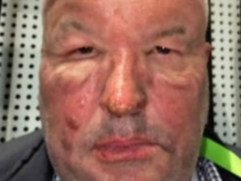 Former NSW police minister David Elliott suffered severe burns to his face in the explosion. Picture: 2GB