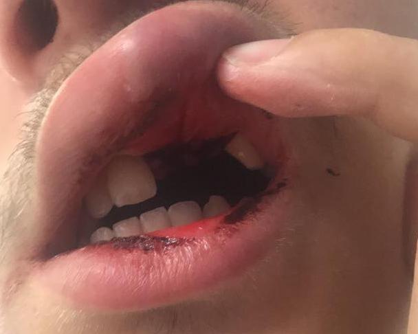 The teenage victim was left without his two front teeth following the New Year’s Eve bashing.