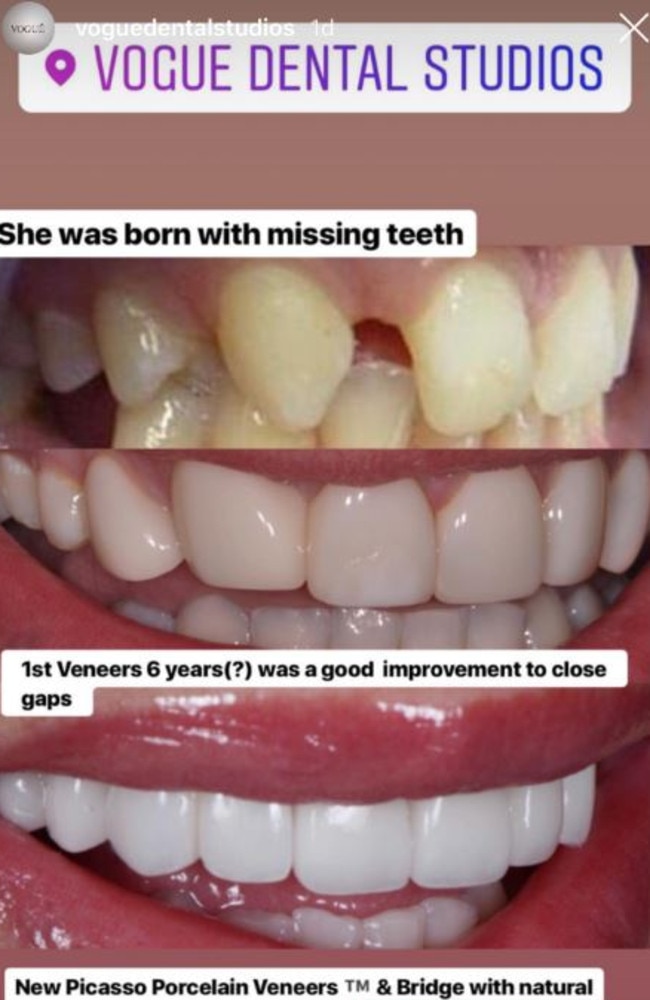 Jess underwent a second veneer procedure after being bullied while on the show.