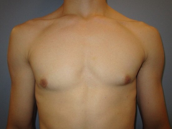 Man boob reduction (gynaecomastia) are also on the rise. Picture: Supplied