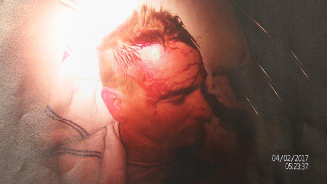 A photograph of Mr Cross’s injuries. Source: Victor Harbor Magistrates Court