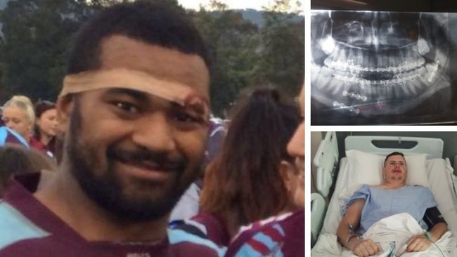 Iliesa Cama has had a successful appeal after he shattered an opponent's jaw in a game in the Upper Hunter Valley. Picture: supplied