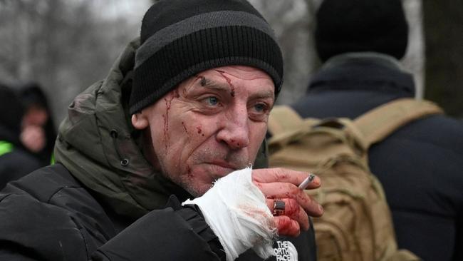 An injured man smokes after a missile strike in Kyiv on December 13. Picture: AFP