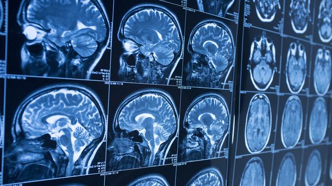 In Australia, 27,428 Australians experienced a stroke for the first time in 2020 and more than 445,000 were living with the ­effects of stroke, according to Stroke Foundation data.