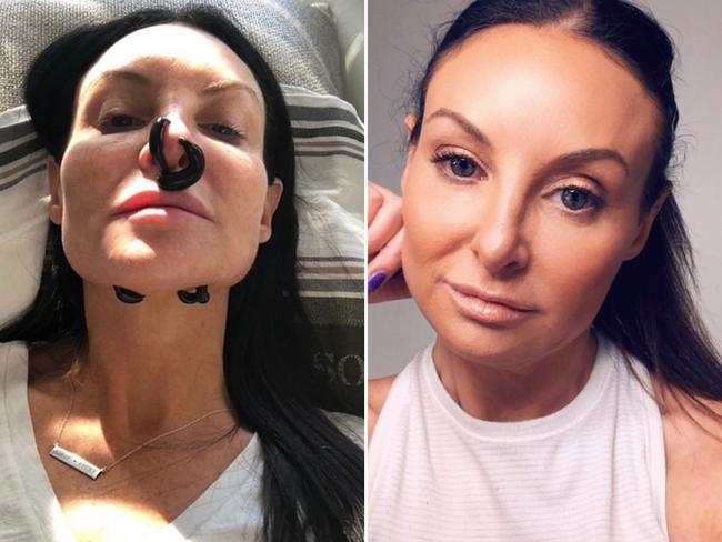 Shari Manchon fixed her botched nose job with leeches.