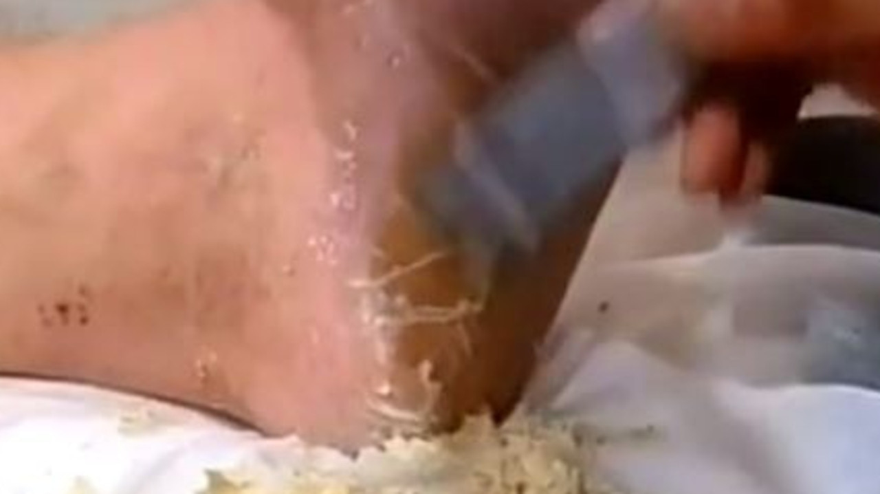 Beautician removes massive pile of dead skin from man's feet