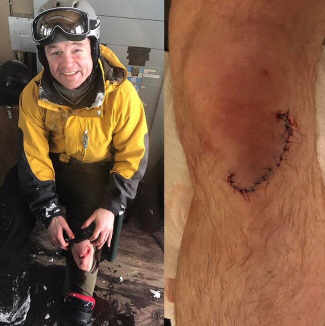 Brian O'Driscoll shows off his skiing scars.