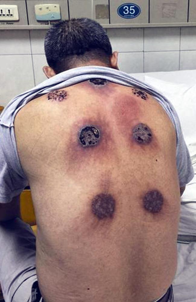 A man was left with seven holes after undergoing cupping therapy to make him feel better. Picture: CEN/Australscope