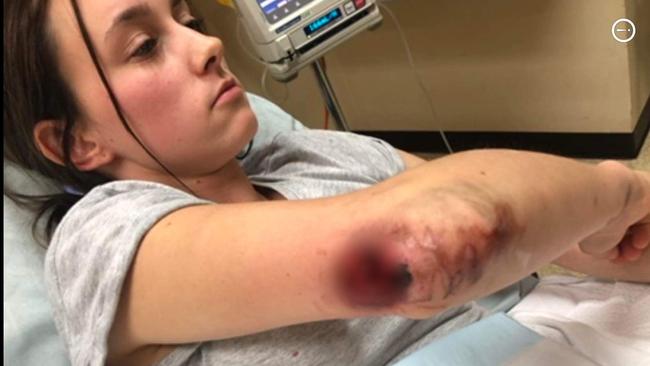 Courtney Herbert after her arm was caught in machinery at a factory in Whyalla. Picture: Supplied