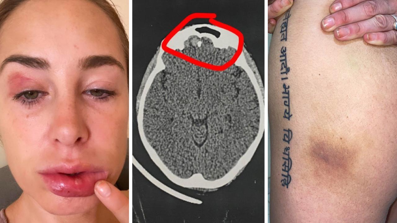 Melbourne DJ Courtney Mills reveals brutal Bali injuries Herald Sun