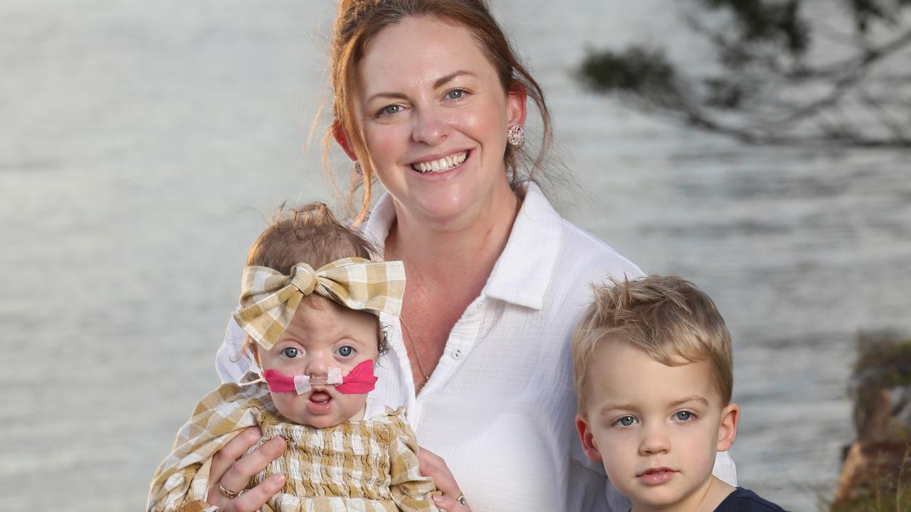 Daisy Stevens: Warwick baby with Apert Syndrome to undergo world ...