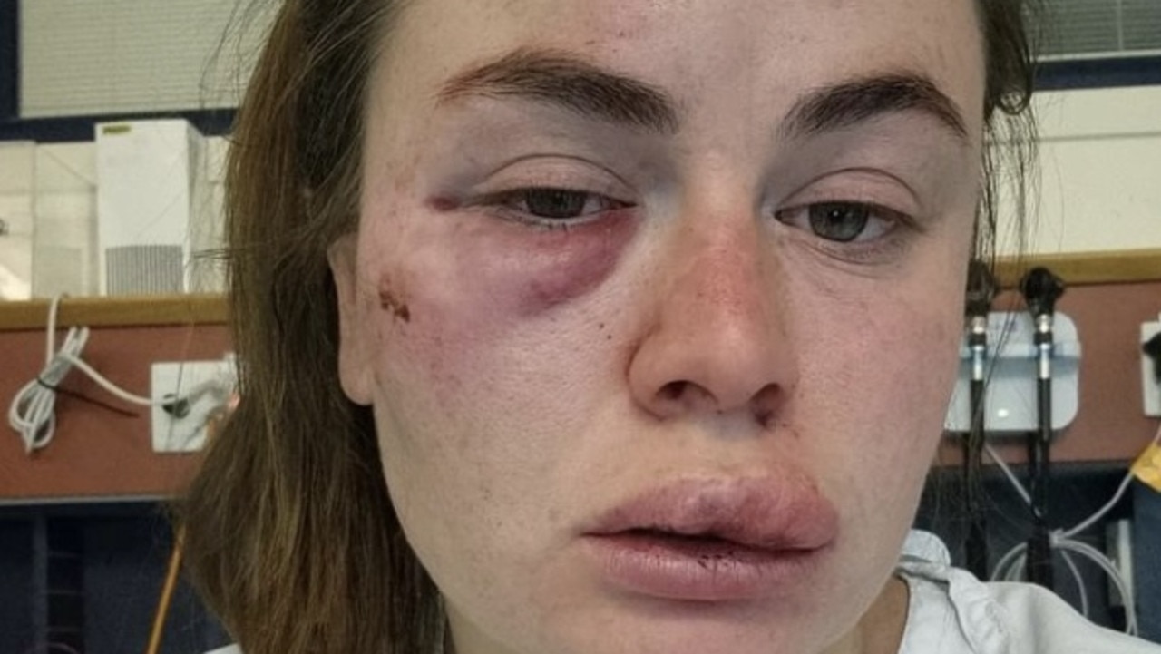 Ballarat Woman Sissy Austin Attacked At Lal Lal State Forest While On A