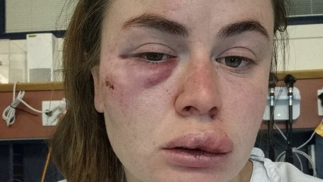 Sissy Austin was attacked while running in a forest near Ballarat.