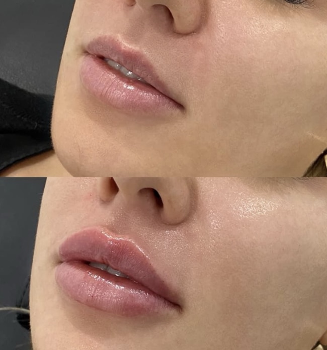 A lovely lift in the top lip with natural volume added at Injex.