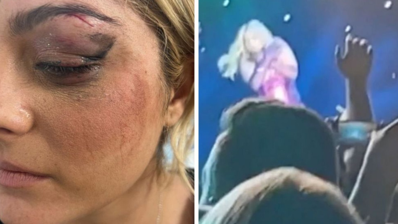 Bebe Rexha shows off gruesome injury after being hit by an iPhone mid-show.