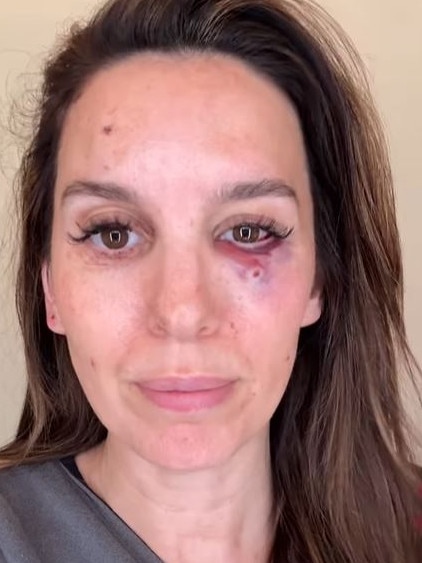 Christy Carlson Romano was “shot in the eye” at while shooting clay pigeons for her husband's birthday outing.