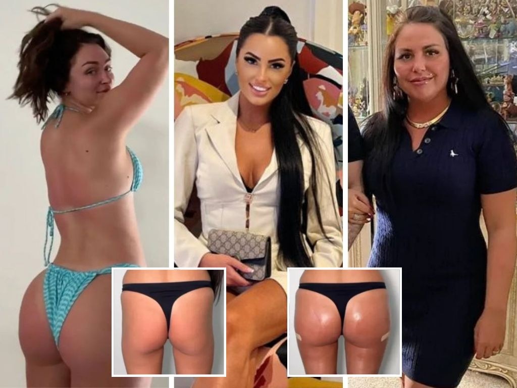 Doctors have issued urgent warnings over Brazilian Butt Lift procedures after a string of botched surgeries and the death this week of Alice Webb (right).